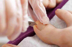 Ingrown Toenail Canberra