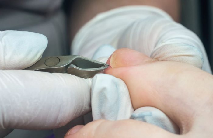 Medical Pedicure Canberra
